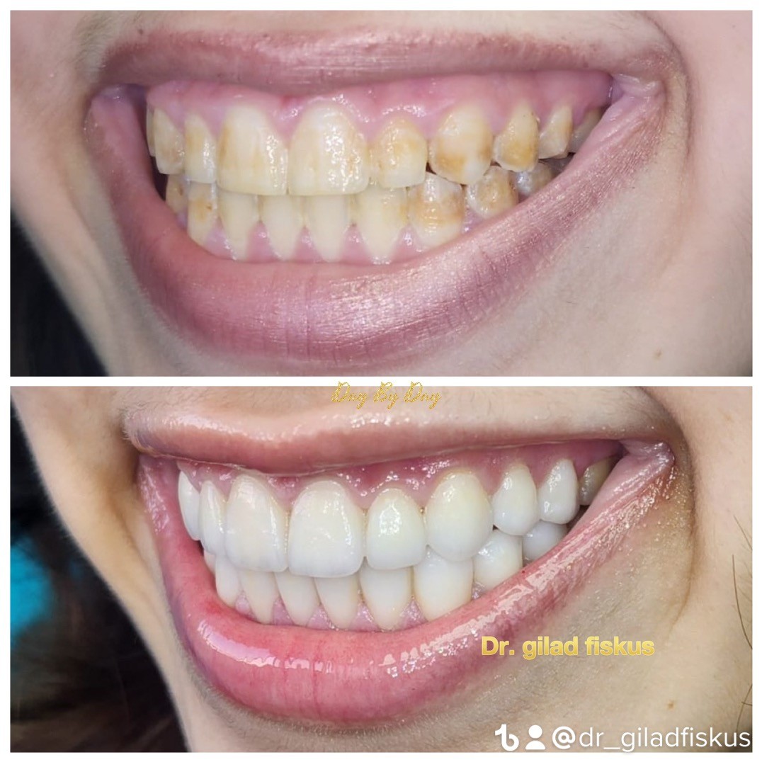 ציפויי חרסינה לשיניים לפני ואחר